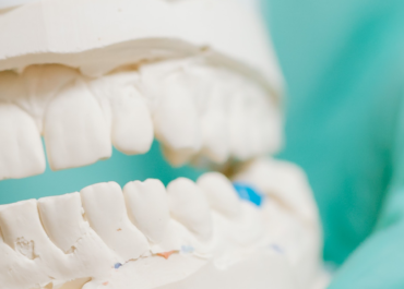 Qual è l'età giusta per gli impianti dentali?